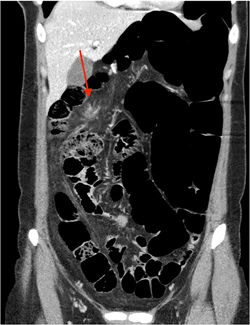 CT abdomen pelvis in 2019 (coronal).