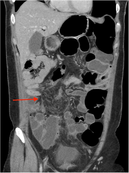 CT abdomen pelvis in 2023 (coronal).