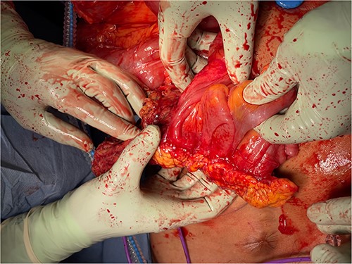 Omental mass with extensive adhesions to small bowel.