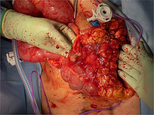 Omental mass with extensive adhesions to ascending colon.