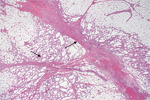 Lower power view of fatty tissue demonstrating a broad band of septal fibrosis, indicating a chronic inflammatory process. Adjacent fat is chronically inflamed and contains a dense infiltrate of foamy histiocytes and some lymphocytes, typical of fat necrosis.