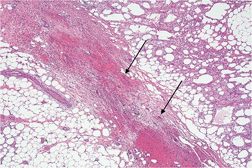 Higher power view demonstrating the thickened fibrous septum with vascular congestion involving small blood vessels.