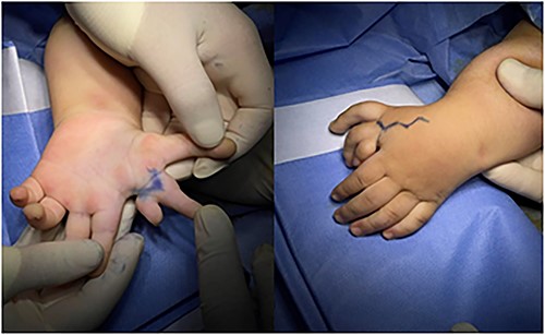 Photographs preoperatively, showing the asymmetrical mirror hand with seven digits arranged in two groups.