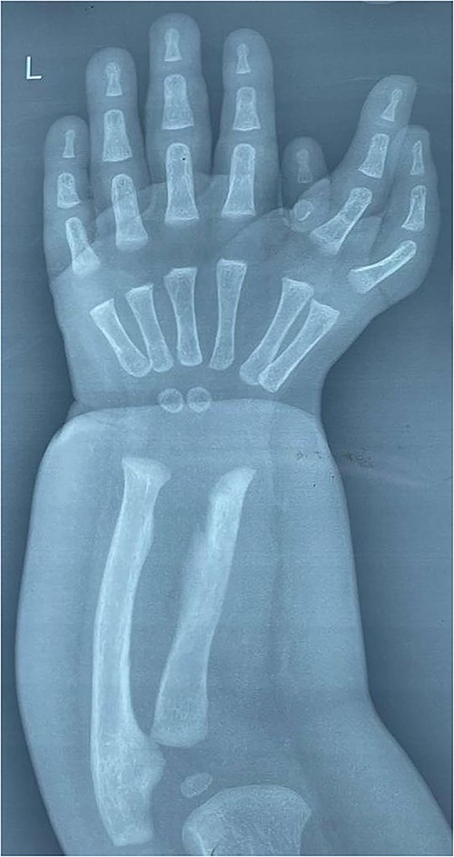 Anteroposterior radiograph of the left wrist, showing one radius and one ulna, the wrist has two ossification centers, the hand bears six triphalangeal digits with six corresponding metacarpals arranged in two groups; there is also rudimentary finger that contains only two bones.