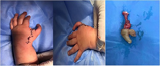 Photographs of the hand after surgery immediately.
