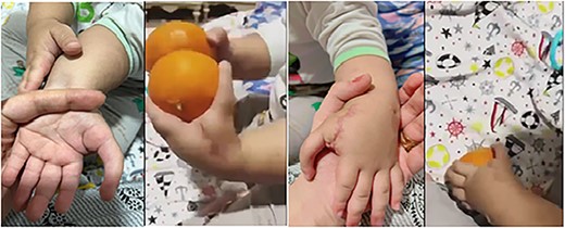 Photographs of the hand 5 months after pollicisation showing normal functiong hand.