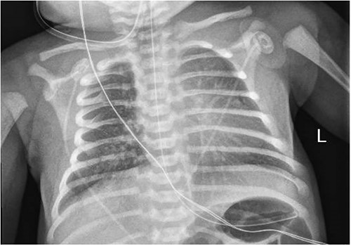 Chest x-ray with right medial lung opacity.