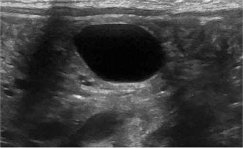 Ultrasound with enteric cyst with gut signature.