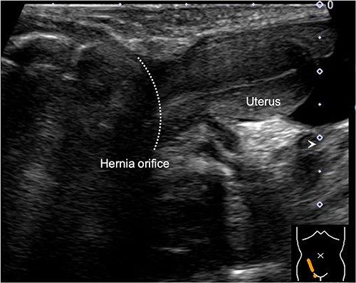 Sagittal view of the inguinal ultrasound at 3 months of age, revealing the presence of uterus protruding into the hernial sac.