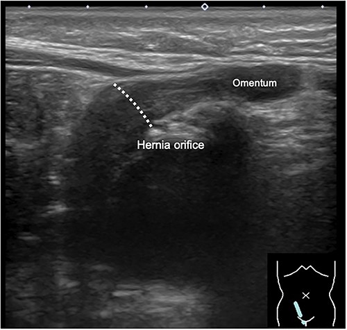 Inguinal ultrasound image captured at 11 months of age, showing herniation of the omentum but no apparent protrusion of the uterus.