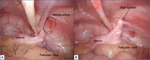 Findings during laparoscopic inguinal hernia repair (Laparoscopic Percutaneous Extraperitoneal Closure: LPEC) conducted at the age of 1 year. (A). Preoperative observations: The patent right inguinal hernia orifice was confirmed. The uterus and fallopian tubes were located close to the hernia orifice, but there was no evident protrusion, and the uterus was not in a position to prolapse. (B). Postoperative observations: High ligation was safely performed, with special attention given to the fallopian tubes.