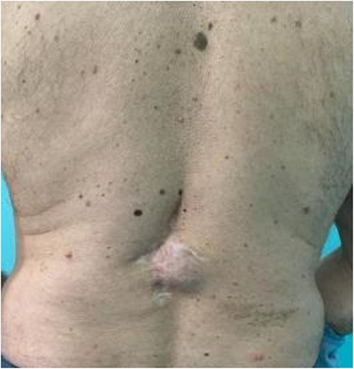 Preoperative local finding.