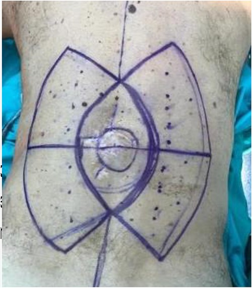 Preoperative markings.