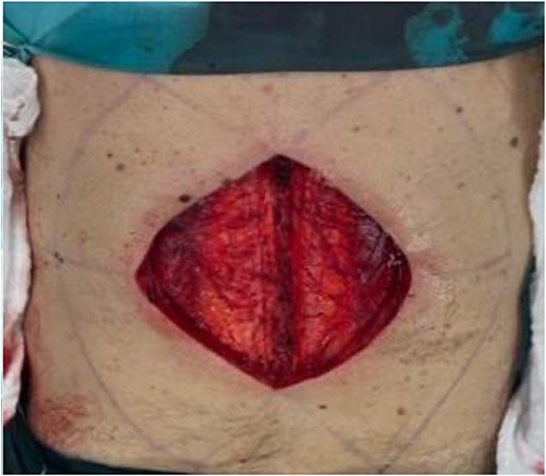 Intraoperative extent of the defect.