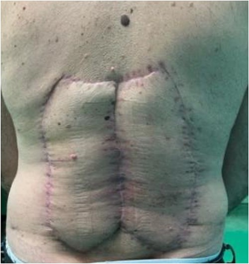 Local findings 1 month after surgery.