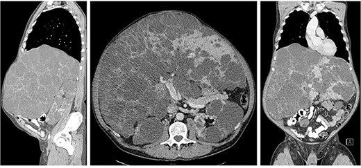 Computed tomography showed extremely enlarged liver with the dimensions of 33 x 21 x 27 cm.
