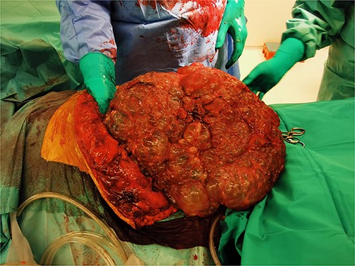Massive hepatomegaly and previous operations made mobilization of the liver very difficult.