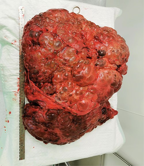 The final pathology revealed the liver measures 53 x 37 x 39 x 16 cm and weight 14,75 kg.