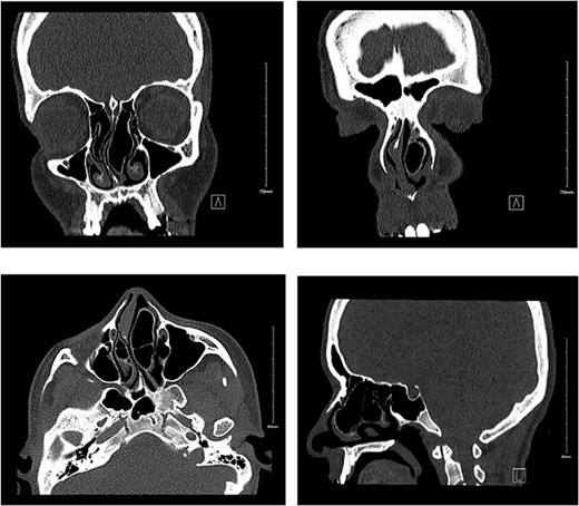 Non-contrast CT showing bilateral pnuematized concha bullosa, more prominent on the left pushing the nasal septum to the right side in coronal (a, b), axial (c), and sagittal (d) views.