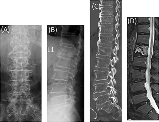 Radiographs showed L1 vertebral body deformation (A, B). CT and MRI STIR revealed anterior bony bridging by DISH and a vertebral fracture in the caudal part of the L1 vertebral body (C, D).