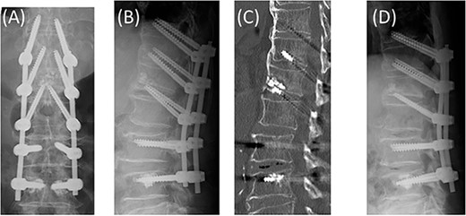 Vertebroplasty with hydroxyapatite grafting on the L1 vertebra via the DEPS trajectory from the L2 vertebra. The DEPS technique to T12, L1, and L2. Conventional pedicle screws to L3 and cement-augmented fenestrated pedicle screws to L4 (A, B, C). No screw loosening or kyphosis progression at 6 months postoperatively (D).