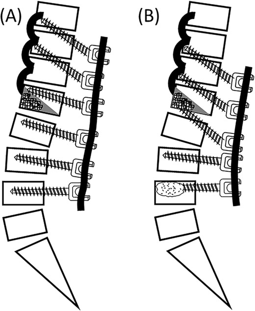 Vertebroplasty via transpedicular trajectory. The DEPS technique to the cranial vertebrae and conventional PPS to the caudal vertebrae (A). Vertebroplasty via the DEPS trajectory. The DEPS technique to the cranial vertebrae and cement-augmented fenestrated pedicle screws to the caudal end vertebra (B).