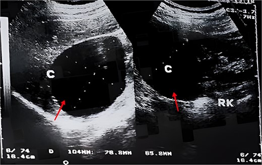 An ultrasonography image showing a cystic mass (arrow) measuring 9 × 9 × 12 cm on the right kidney.