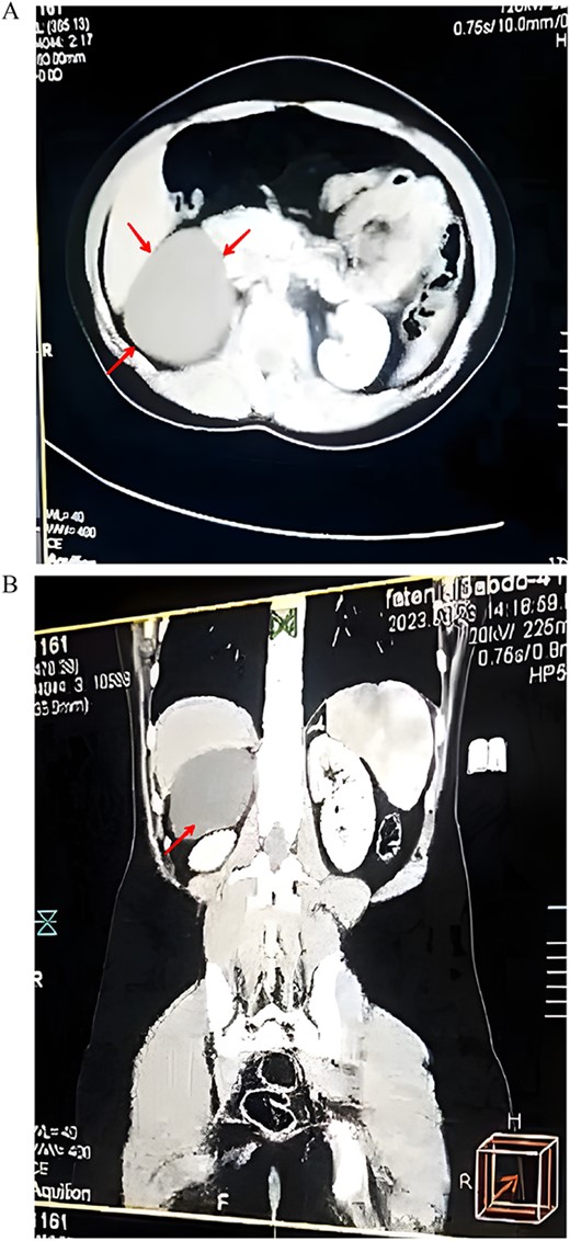 (A) An axial CT scan showing a well-defined suprarenal cyst (arrow). (B) A coronal CT scan of the abdomen showing the location of the cysts in the right upper quadrant (arrow).