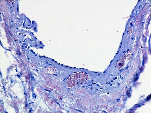Histopathology shows parts of the cyst’s wall lined by a single layer of cuboidal or flattened epithelium.
