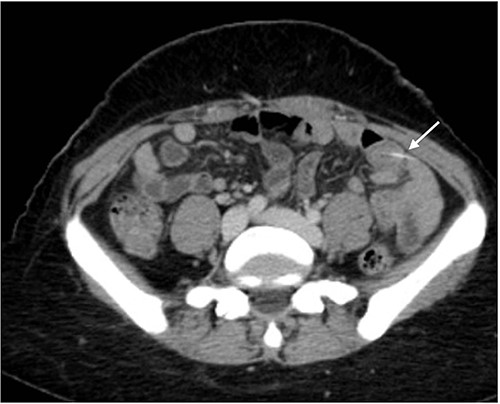 Axial views of contrast-enhanced CT of the abdomen showed a transversely oriented linear hyperdense FB (arrow) structure seen within the ilea loops in the lower quadrant.
