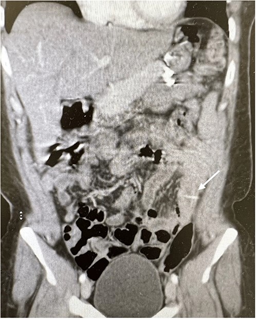 Coronal views of contrast-enhanced CT abdomen showed: a transversely oriented linear hyperdense FB (arrow) structure seen within the ilea loops in the lower quadrant.