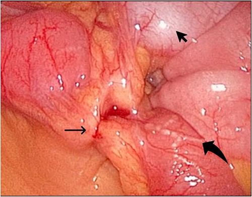 The laparoscopic exploration showed the sigmoid colon attached to the area of the inflammatory reaction; straight arrow: site of the toothpick; curved arrow: site of toothpick erosion through the bowel wall; arrowhead: sigmoid colon.