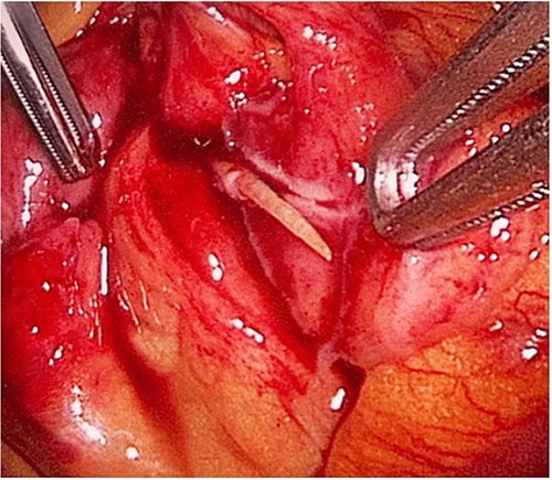 The laparoscopic exploration showed a FB in the mesentery of two loops of the ileum 100 cm from the ileocecal junction—upon partial exposure of the site of the toothpick.