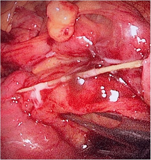 The laparoscopic exploration showed a FB in the mesentery of two loops of the ileum 100 cm from the ileocecal junction—after full exposure of the site of the toothpick.