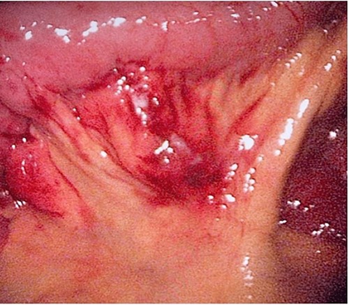 Site of the toothpick after removal.