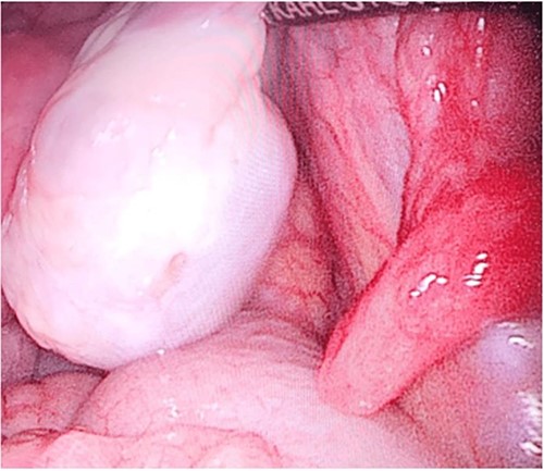 Right ovary.