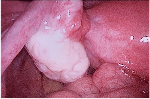 Left ovary.