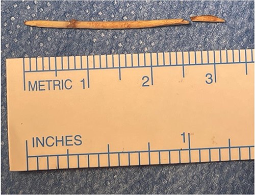 The FB was identified as a toothpick, 3 cm in length.