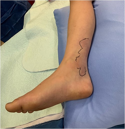 The patient’s right leg upon presentation to the tertiary care hospital, with the area of erythema and edema outlined with a skin marker.