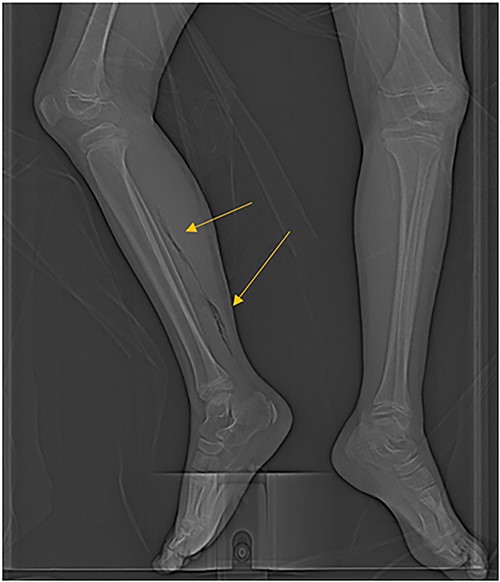 CT scan demonstrating extensive air in the soft tissue of the right leg.