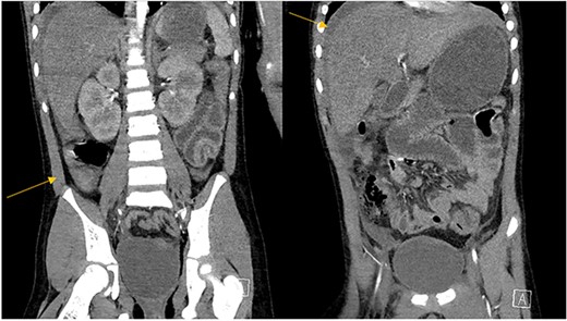Abdominal CT scan demonstrating intrabdominal free fluid and a collection in the right lower quadrant.