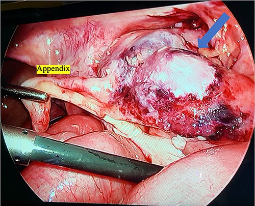 Intraoperative photograph of the ileocecal junction with extensive inflammation and necrosis.