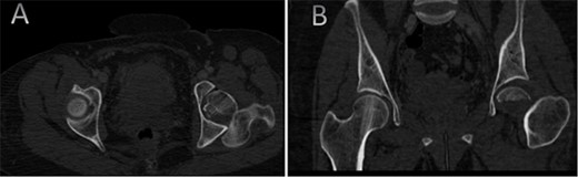 CT scan of the chest, abdomen, and pelvis showing axial (A) and coronal (B) cuts of a left sided Pipkin I fracture comprising large surface of the femoral head with posterior hip dislocation.