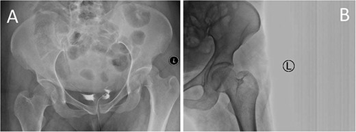 Prereduction anteroposterior (AP) radiographs of the pelvis showing a left side fracture dislocation of the left proximal femur (A) and postreduction radiographs of the left hip (B) showing a concentric hip joint.