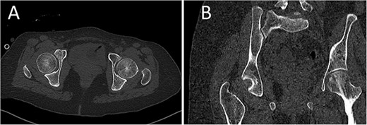 CT scan of the pelvis showing axial (A) and coronal (B) cuts at 6-week post-injury showing signs of healing of the left fractured femoral head with a concentric hip joint.