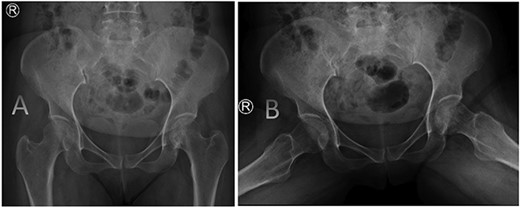 AP radiographs (A) and frog leg lateral (B) radiographs at 3-year follow-up showing a concentrically reduced hip.