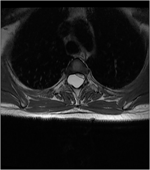 Axial T2 Image showing flattened cord displaced to the left.