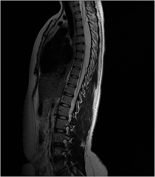 T2 sagittal showing dorsal cord compression.