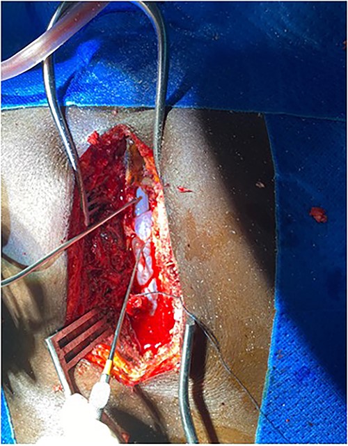 Intraop showing cyst and spinal cord.