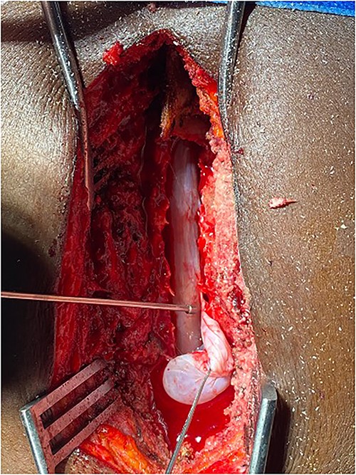 Fistulous connection of the cyst with spinal cord subarachnoid space.